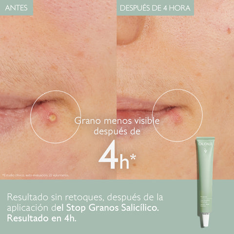 Caudalie Vinopure Stop Granos Salicílico