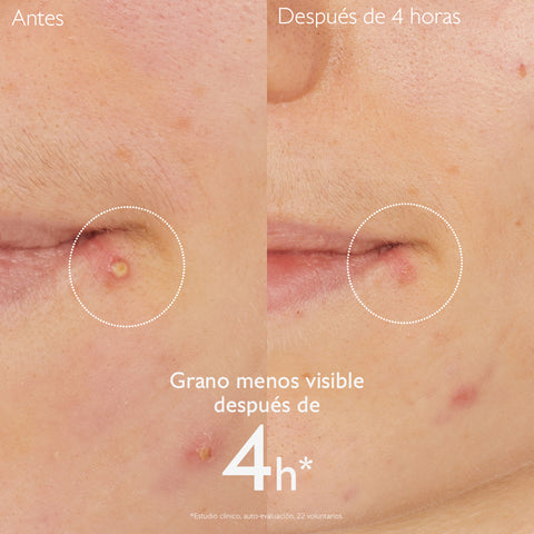 Caudalie Vinopure Stop Granos con Acido Salicílico